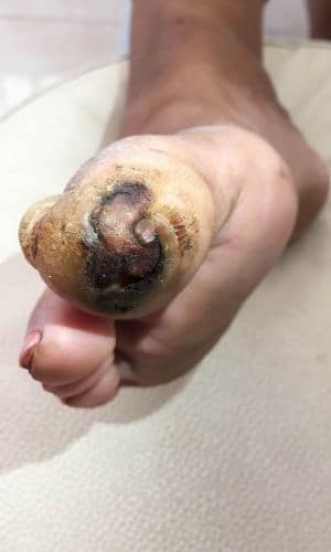 severe sores on feet from peripheral neuropathy